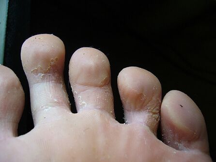 Беленето и лющенето на кожата на краката е признак на гъбички