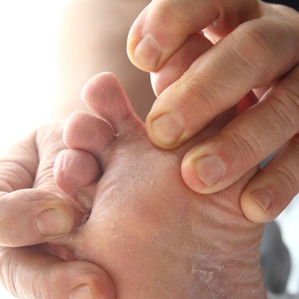 Гъбичките засягат кожата между пръстите на краката