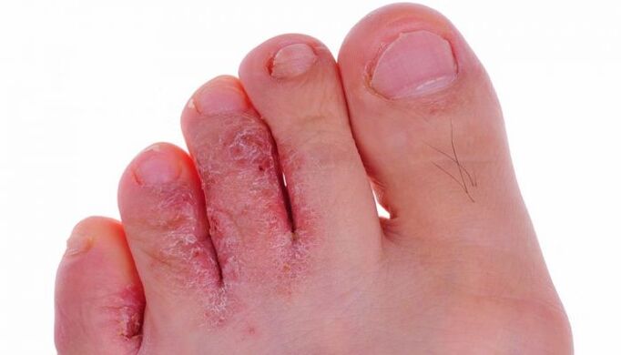 гъбична инфекция на кожата на пръстите на краката