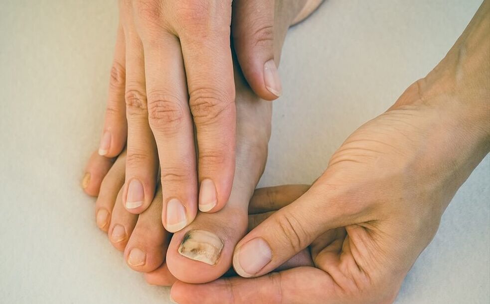 гъбички по ноктите на краката как да се лекува