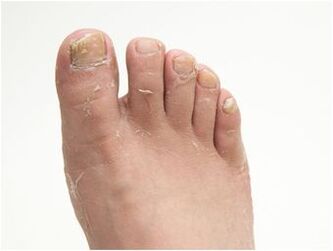 симптоми на гъбички по краката