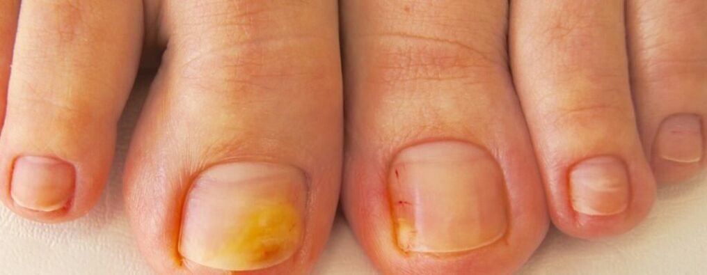 Началният стадий на онихомикоза - пожълтяване на ноктите на краката