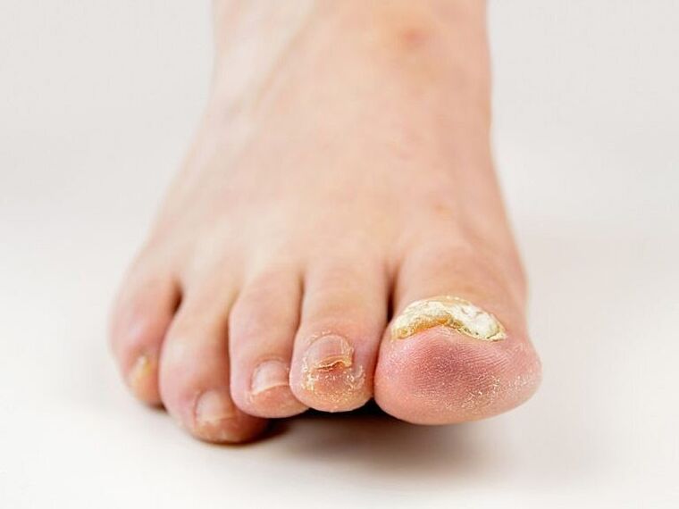 Удебеляване на нокътната плочка на палеца на крака с гъбички