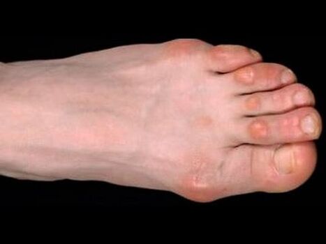 гъбички по крака