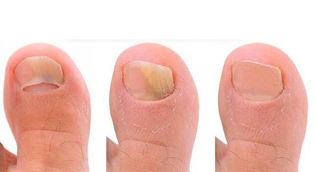 етапи на развитие на гъбички по ноктите на краката
