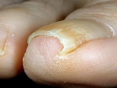 Поява на ноктите на краката, заразени с гъбички