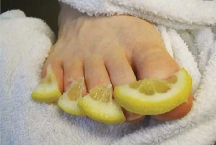 Компреси от лимонови капки - народен лек за гъбички по ноктите