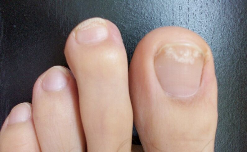 Първоначалните признаци на гъбички са промяна в цвета на нокътната плочка, появата на петна